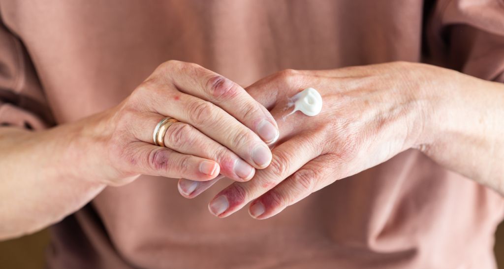 Miglior crema per dermatite atopica